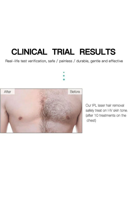 Ipl Laser Hair Removal Handset